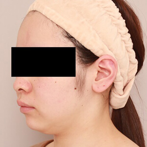 顔（頬・顎下）の脂肪吸引【術前／3ヶ月 25歳女性】の術前写真