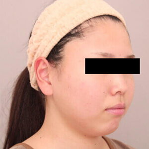 顔（頬・顎下）の脂肪吸引【術前／1ヶ月 30歳女性】の術前写真
