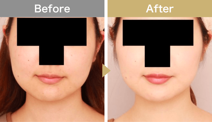 頬・顎下の脂肪吸引【術前／3ヶ月 21歳女性】正面