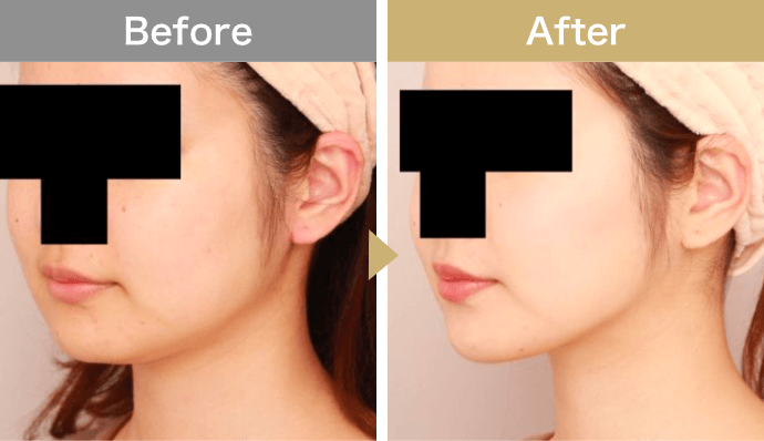 頬・顎下の脂肪吸引【術前／3ヶ月 21歳女性】斜め