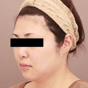 顔（頬・顎下）の脂肪吸引【術前／3ヶ月 36歳女性】の術前写真