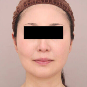 顔（頬・顎下）の脂肪吸引【術前／1ヶ月 46歳女性】の術後写真
