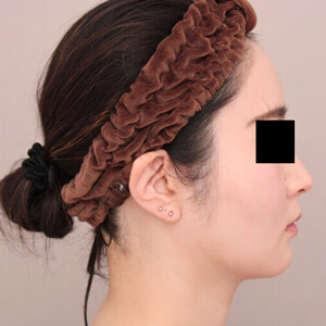 顔（頬・顎下）の脂肪吸引【術前／1ヶ月 30歳女性】の術後写真