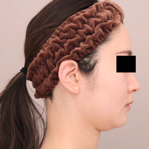 顔（頬・顎下）の脂肪吸引【術前／1ヶ月 30歳女性】の術前写真