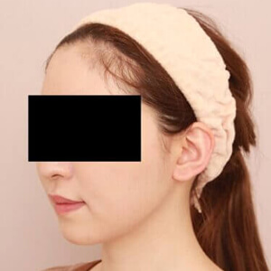 顔（頬・顎下）の脂肪吸引【術前／3ヶ月 25歳女性】の術後写真