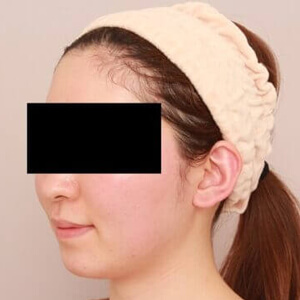 顔（頬・顎下）の脂肪吸引【術前／3ヶ月 25歳女性】の術前写真