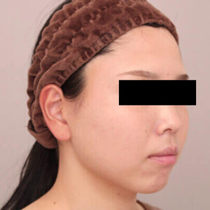 顔（頬・顎下）の脂肪吸引【術前／1ヶ月 30歳女性】の術後写真