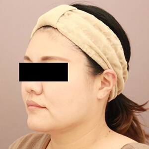 顔（頬・顎下）の脂肪吸引【術前／6ヶ月 36歳女性】の術後写真