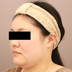 顔（頬・顎下）の脂肪吸引【術前／6ヶ月 36歳女性】の術前写真