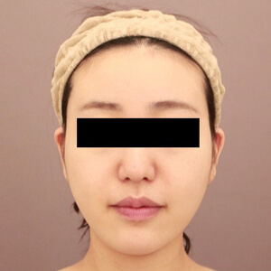 顔（頬・顎下）の脂肪吸引【術前／3ヶ月 24歳女性】の術後写真