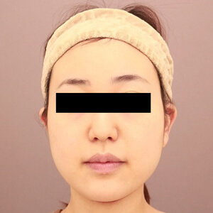 顔（頬・顎下）の脂肪吸引【術前／3ヶ月 24歳女性】の術前写真
