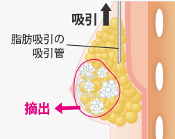 2.摘出・吸引