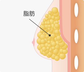 偽性女性化乳房タイプ