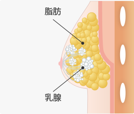 混合性女性化乳房タイプ
