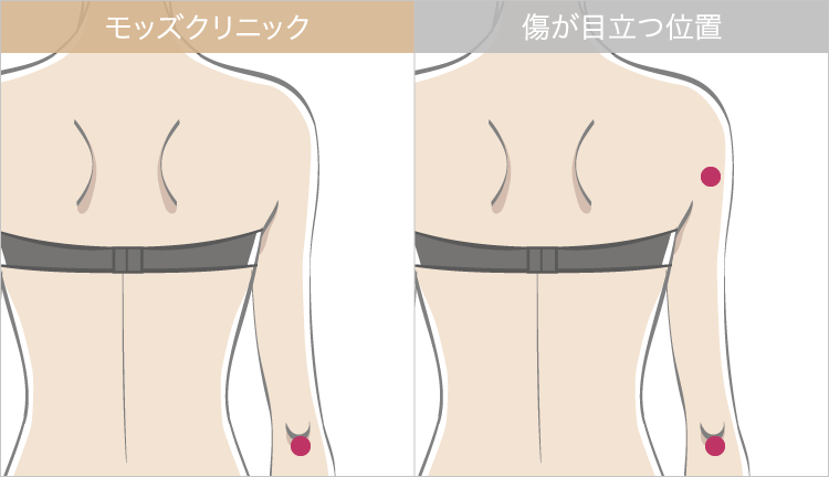 施術直後から動ける